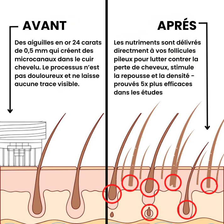 Simira™ Système de repousse des cheveux