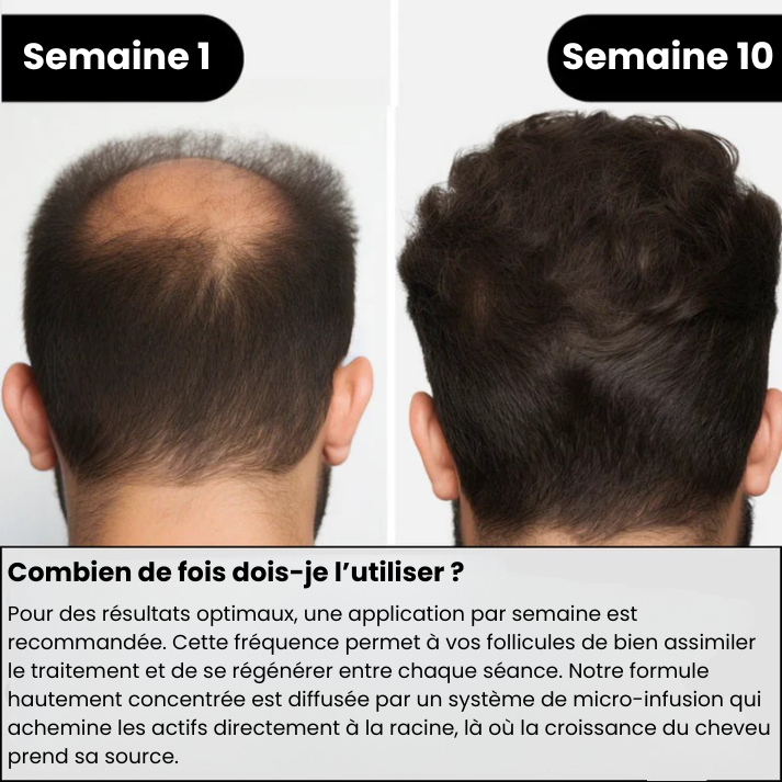 Simira™ Système de repousse des cheveux