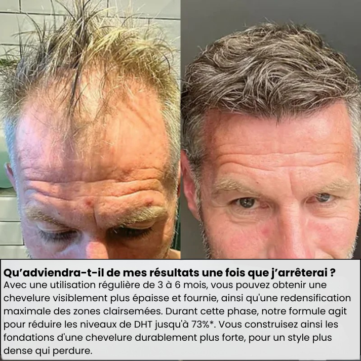 Simira™ Système de repousse des cheveux